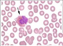 嗜酸粒细胞病理图 嗜酸粒细胞病理图